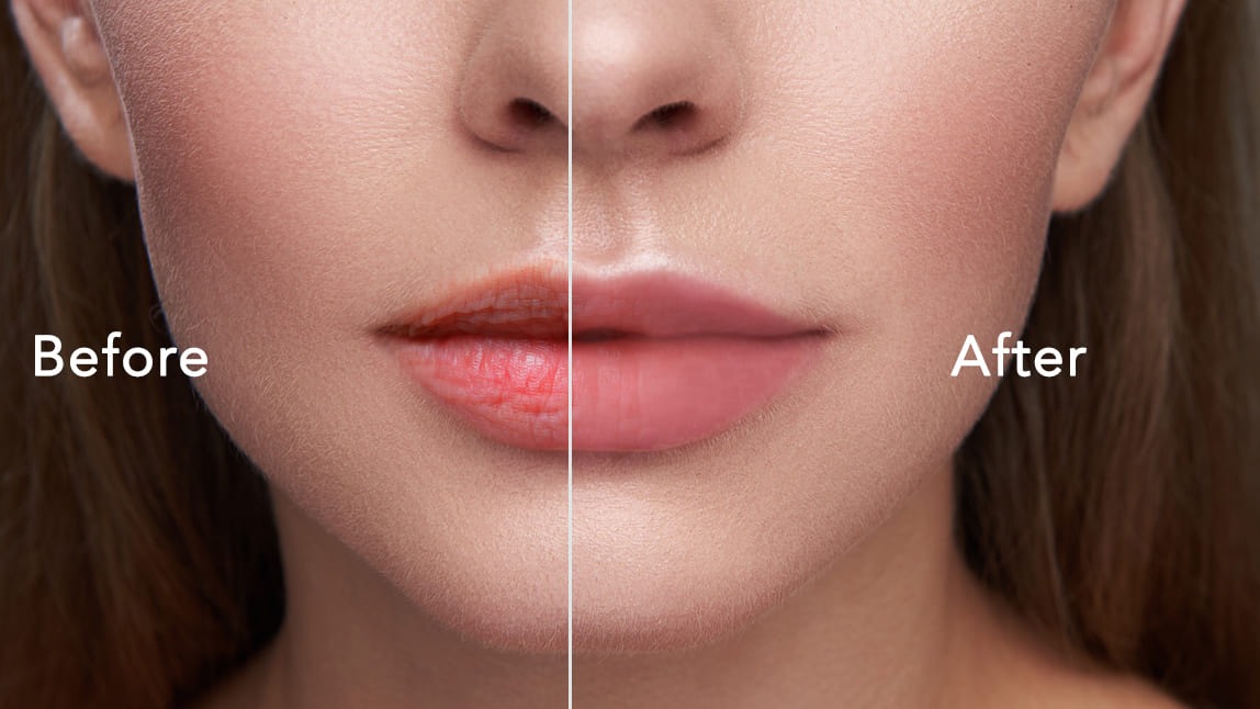 పెదవులపై ముడుతలను ఎలా వదిలించుకోవాలి – get rid of wrinkles on lips