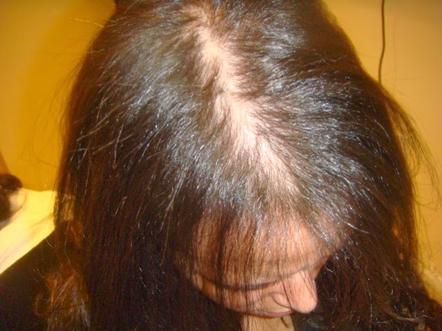 స్త్రీలకు బట్టతల కారణాలు మరియు చికిత్స – Female pattern baldness
