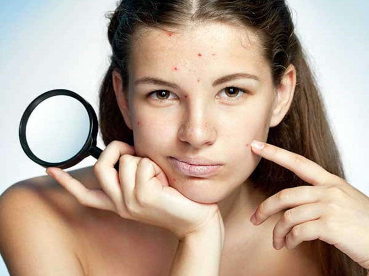 పింపుల్స్ ను తొలగించడం ఎలా  – Best tips for Pimples