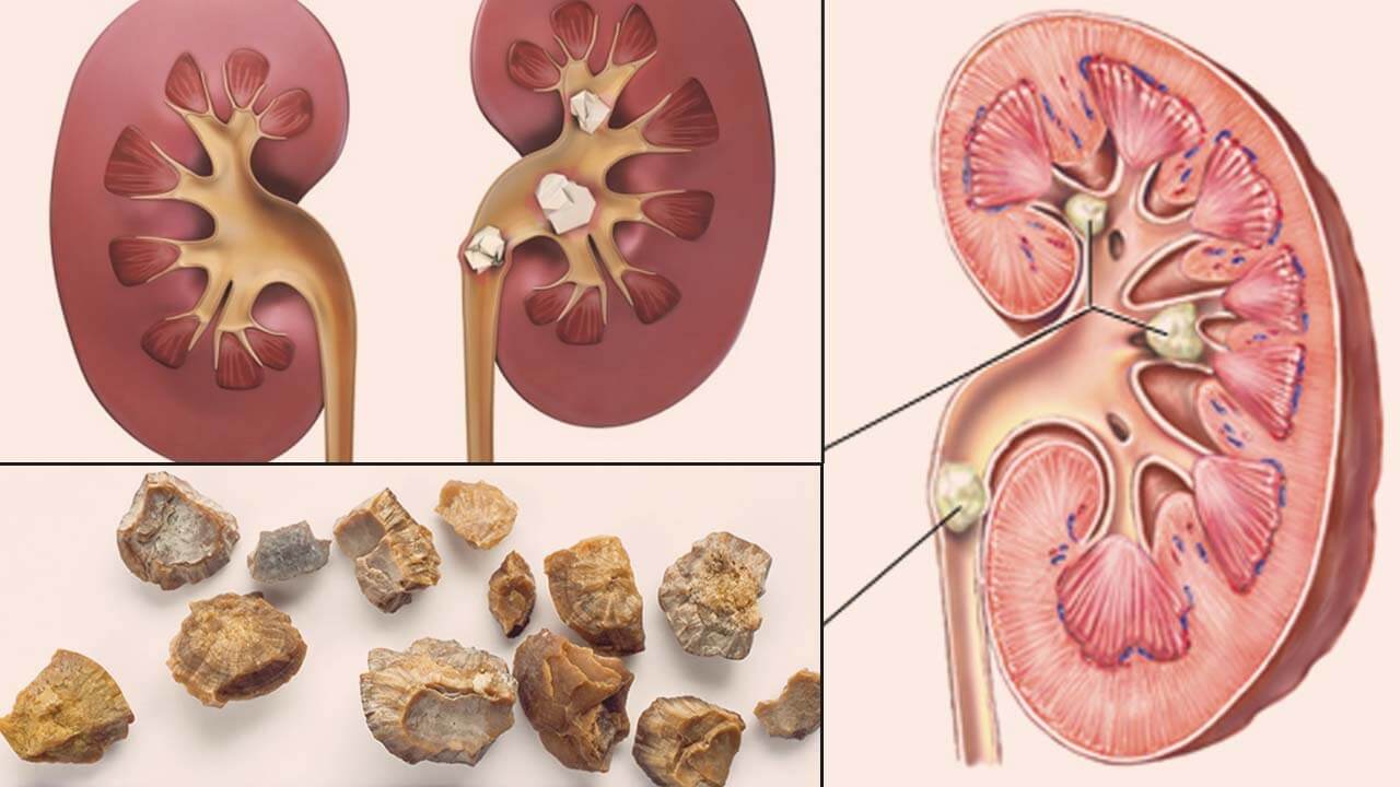 మూత్రపిండాల్లో రాళ్ల మొదటి సంకేతాలు ఏమిటి-First signs of kidney stones.
