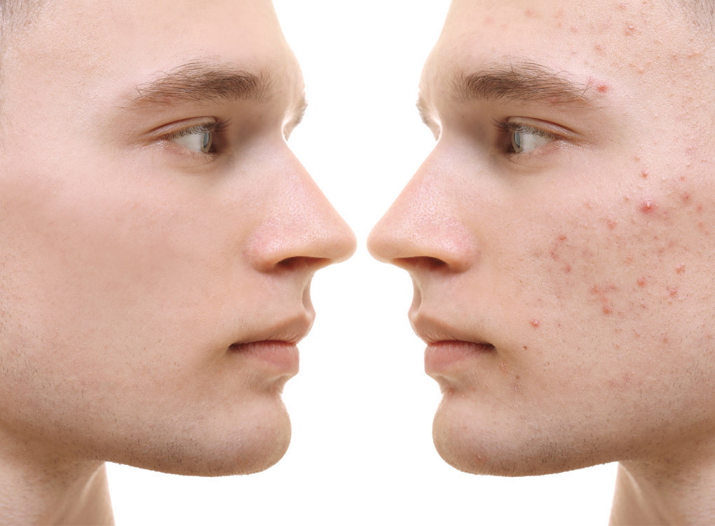 పురుషుల మొటిమలకు ఉత్తమ చిట్కాలు – Treating acne in men