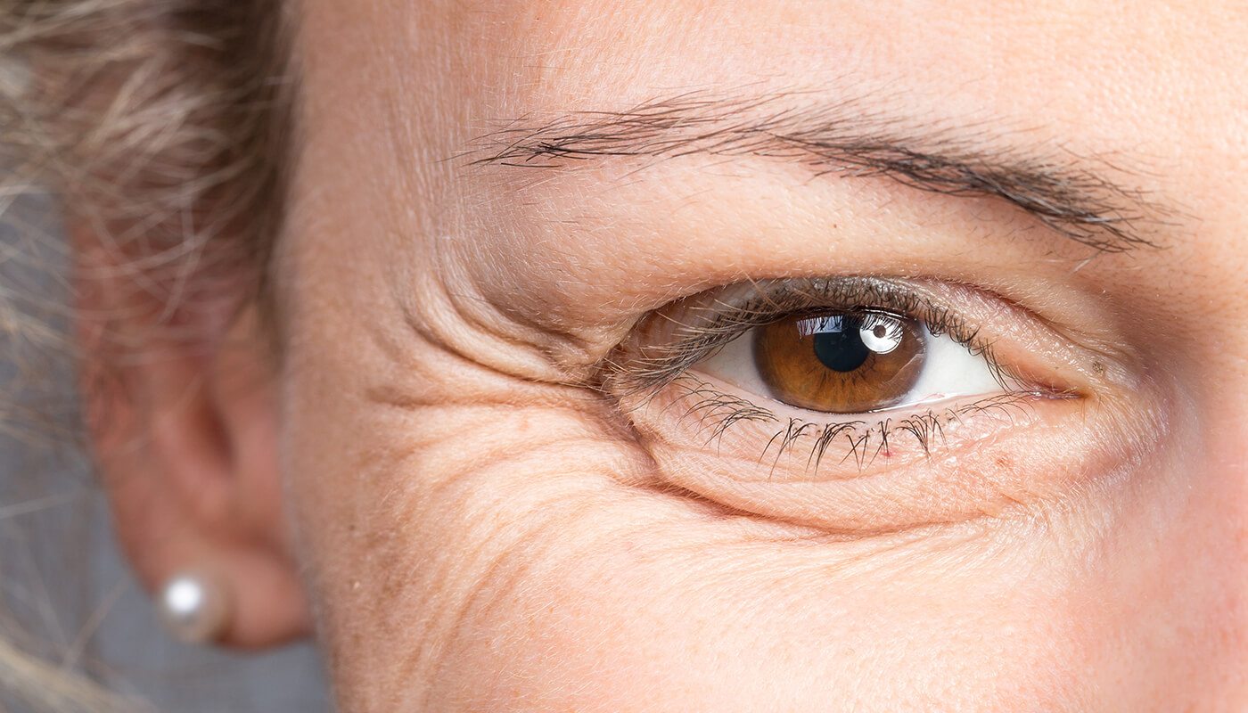 కళ్ళు/కనురెప్పల పైన ముడుతలను ఎలా తొలగించాలి – Wrinkles Above Eyes/Eyelids