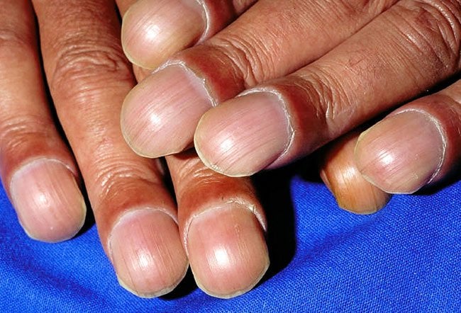నెయిల్ క్లబ్బింగ్ వదిలించుకోవటం ఎలా – లక్షణాలు మరియు నాచురల్ రెమెడీస్ – How to get rid of nail clubbing – Symptoms and natural remedies