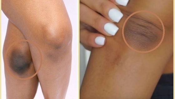 ఇంట్లో మోచేతి మరియు మోకాలి బ్లీచింగ్ ఎలా చేయాలి – How to do elbow and knee bleaching at home