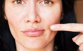పెదవిపై మొటిమను ఎలా పాప్ చేయాలి? – How to pop a pimple on lip?