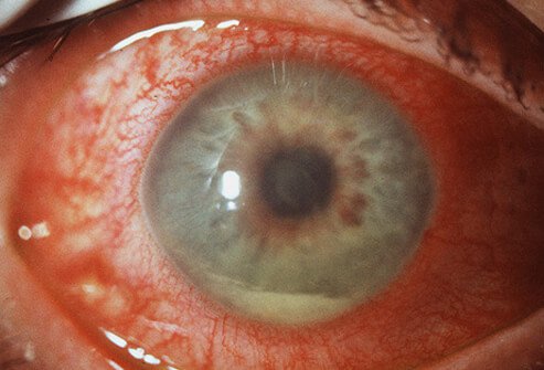కళ్లు తేలేవా? – ఐ ఫ్లోటర్స్‌ను ఎలా తగ్గించాలి-Reduce Eye Floaters