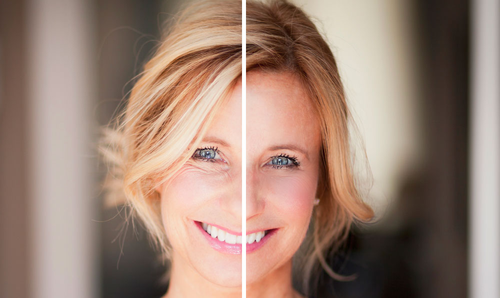 బమ్ కింద ముడతలు వదిలించుకోవటం ఎలా – How to get rid of wrinkles under bum
